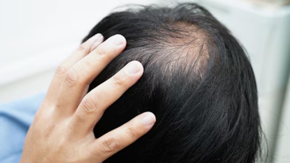 Tips for Choosing Hair Loss Treatment for Men Wisely