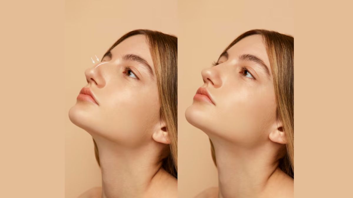 What Patients Should Know About Rhinoplasty In Perth