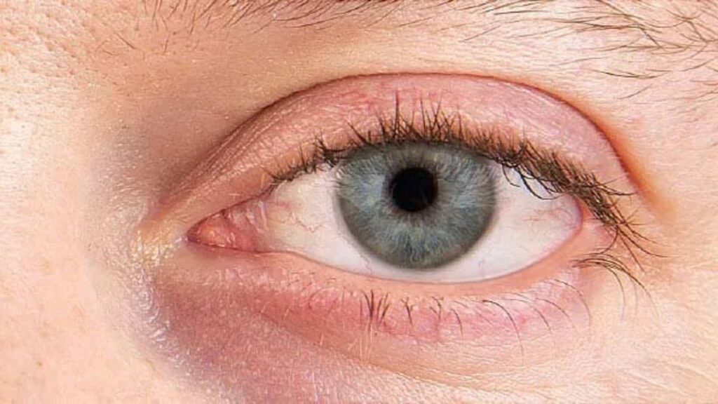 Why Dry Eye Relief is Essential for Comfortable Contact Lens Wear