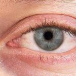 Why Dry Eye Relief is Essential for Comfortable Contact Lens Wear